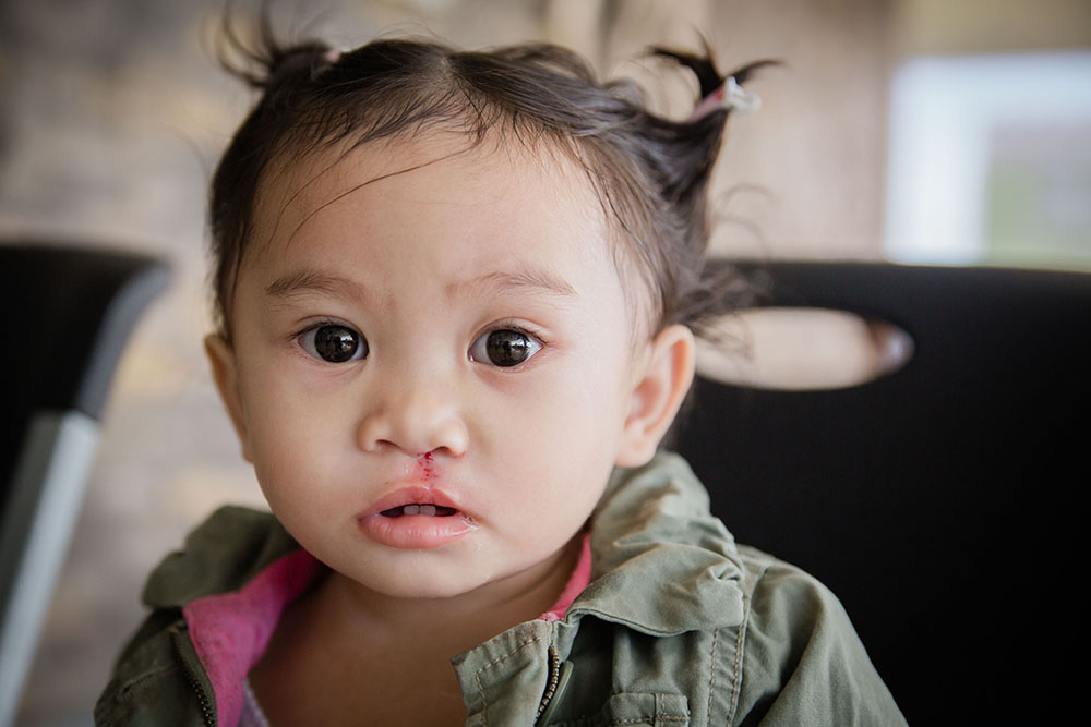 Andrea after cleft surgery