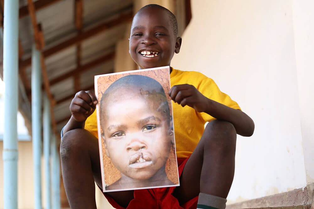 2014: Smile Train sponsors their 1,000,000th cleft surgery, on a child named Osawa in Tanzania.