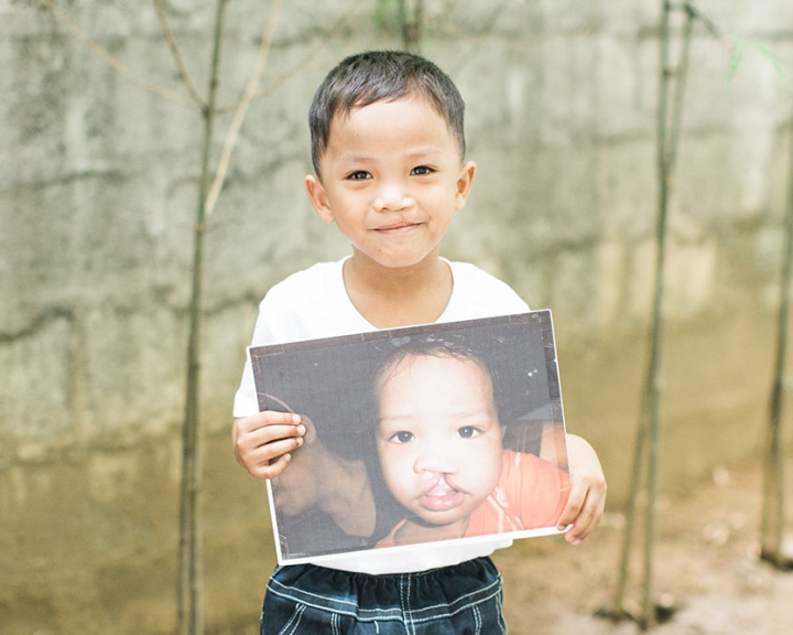 boy holds image of himself before cleft lip surgery