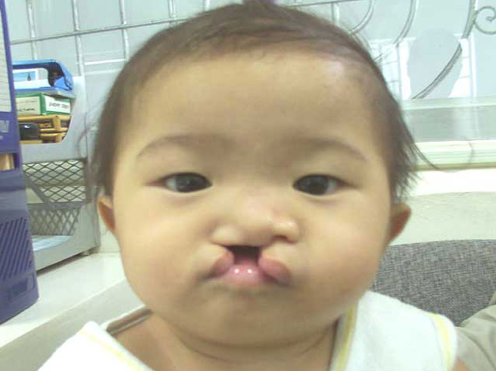 Jian before cleft surgery