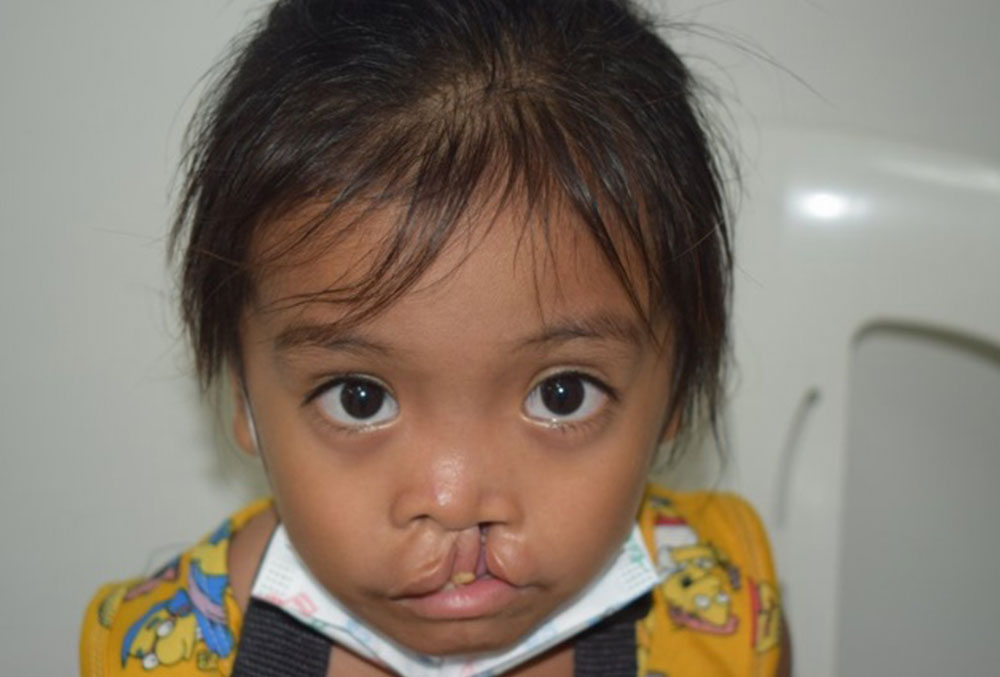 Ernie Pacatang, Jr. before cleft surgery