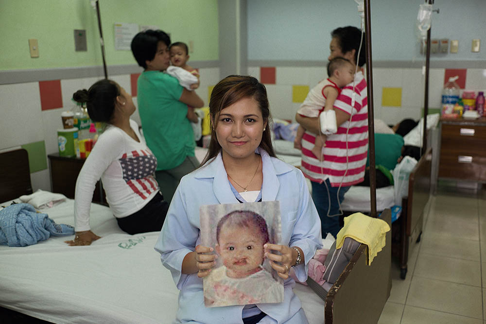 Angel holds image of herself before cleft lip surgery