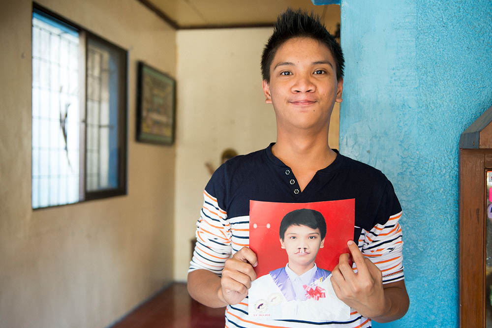 Joseph holds image of himself before cleft lip surgery