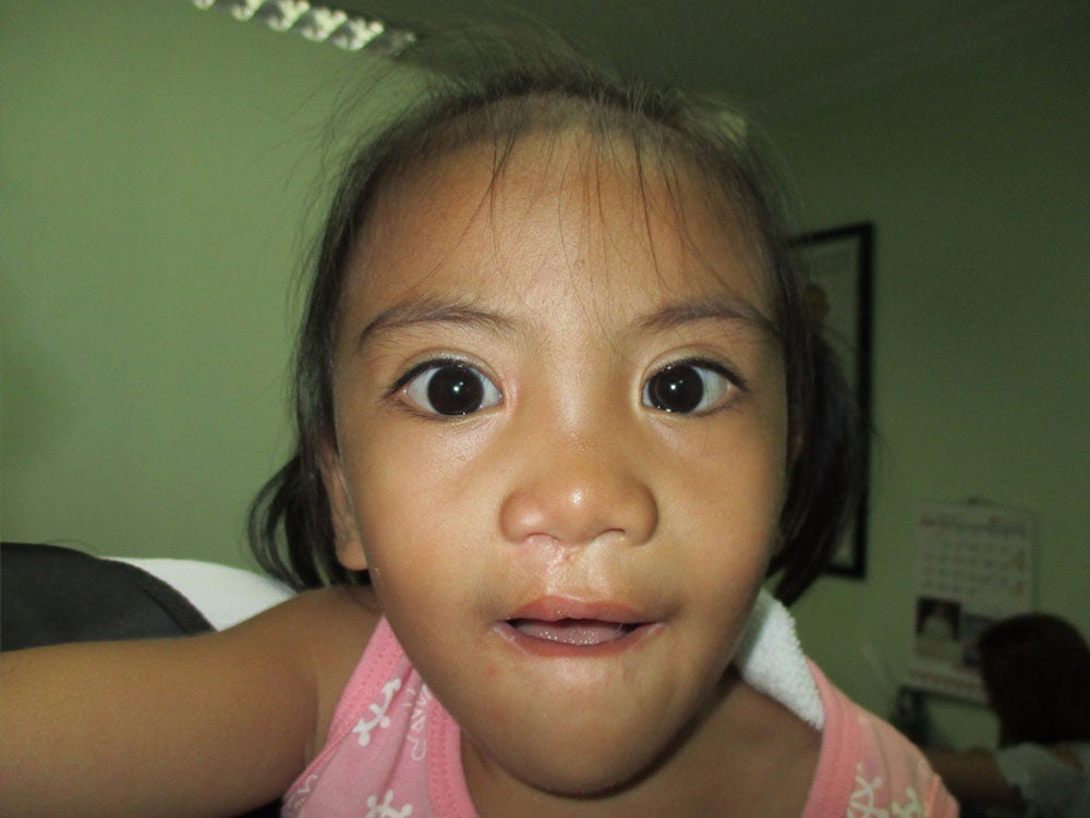 Angel after cleft palate surgery