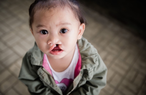 Andrea before cleft surgery