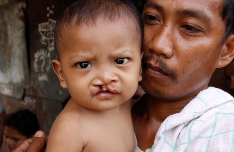 child held by father with a cleft lip