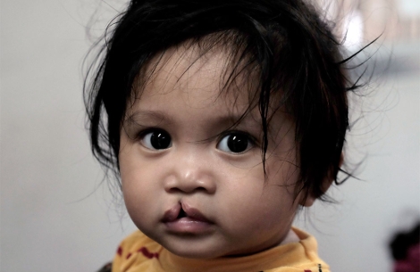 boy with untreated cleft lip