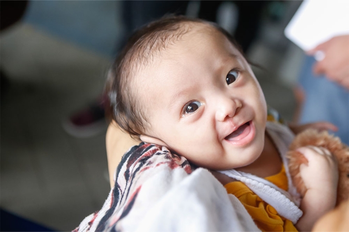 Child after cleft surgery