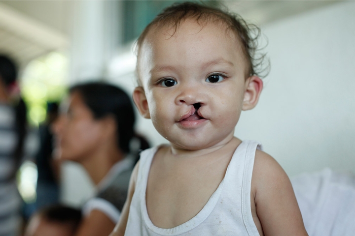 boy with cleft lip