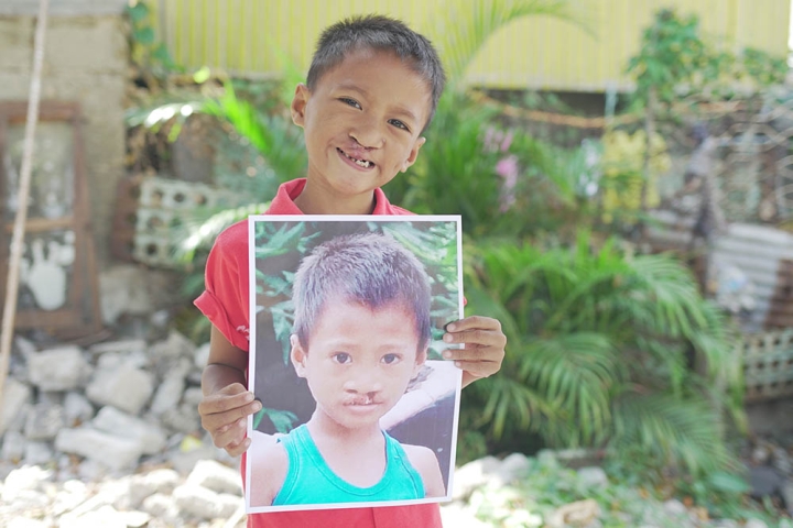 Aldrian holds image of himself before cleft surgery