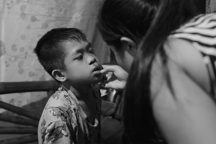 Jessa inspecting Jary’s sutured wound after his cleft surgery