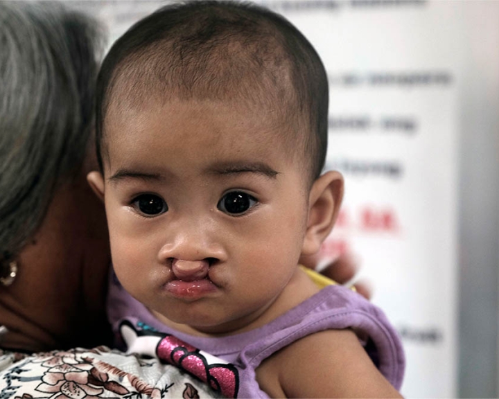 child with bilateral cleft lip