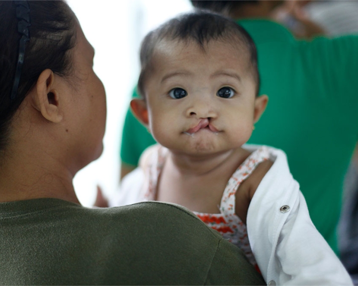 baby with a cleft lip looks over moms shoulder