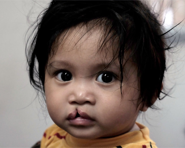 boy with untreated cleft lip