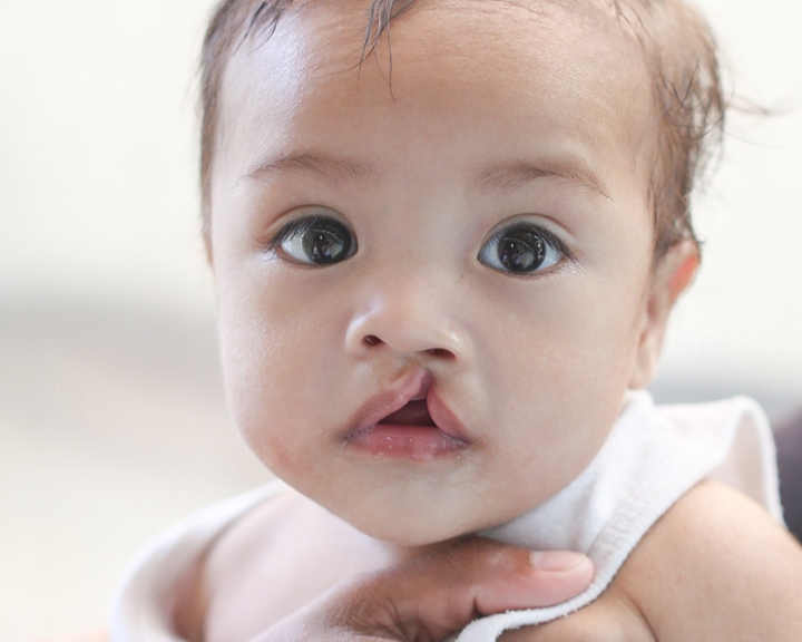 child with cleft lip