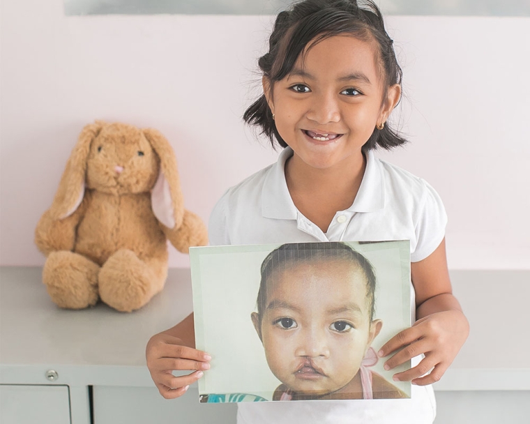 Child holds image of self before cleft lip surgery