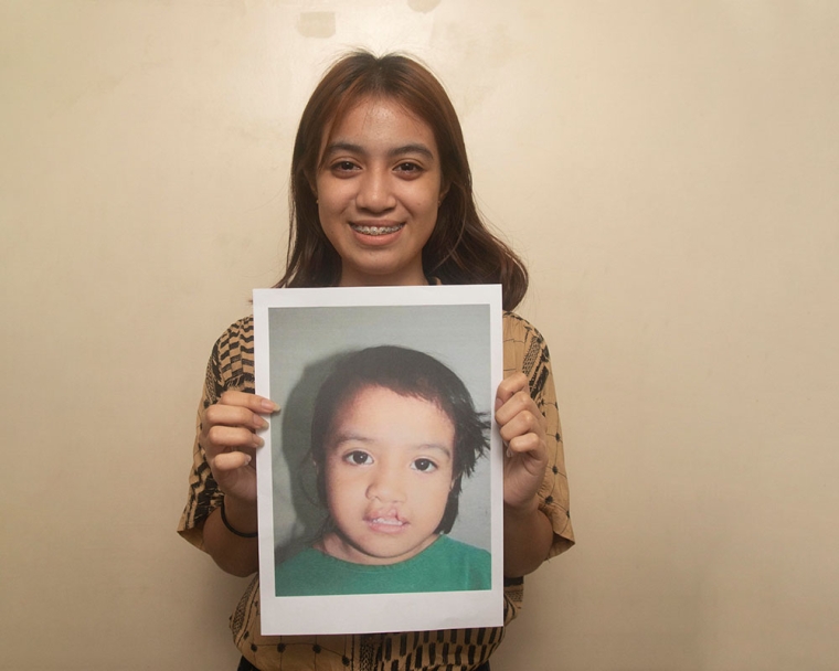 Woman holds image of herself as cleft lip patient